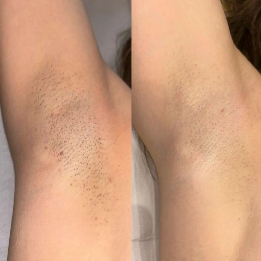 Cypéréa™ -  Serum anti-repousse de poils