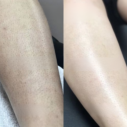 Cypéréa™ -  Serum anti-repousse de poils